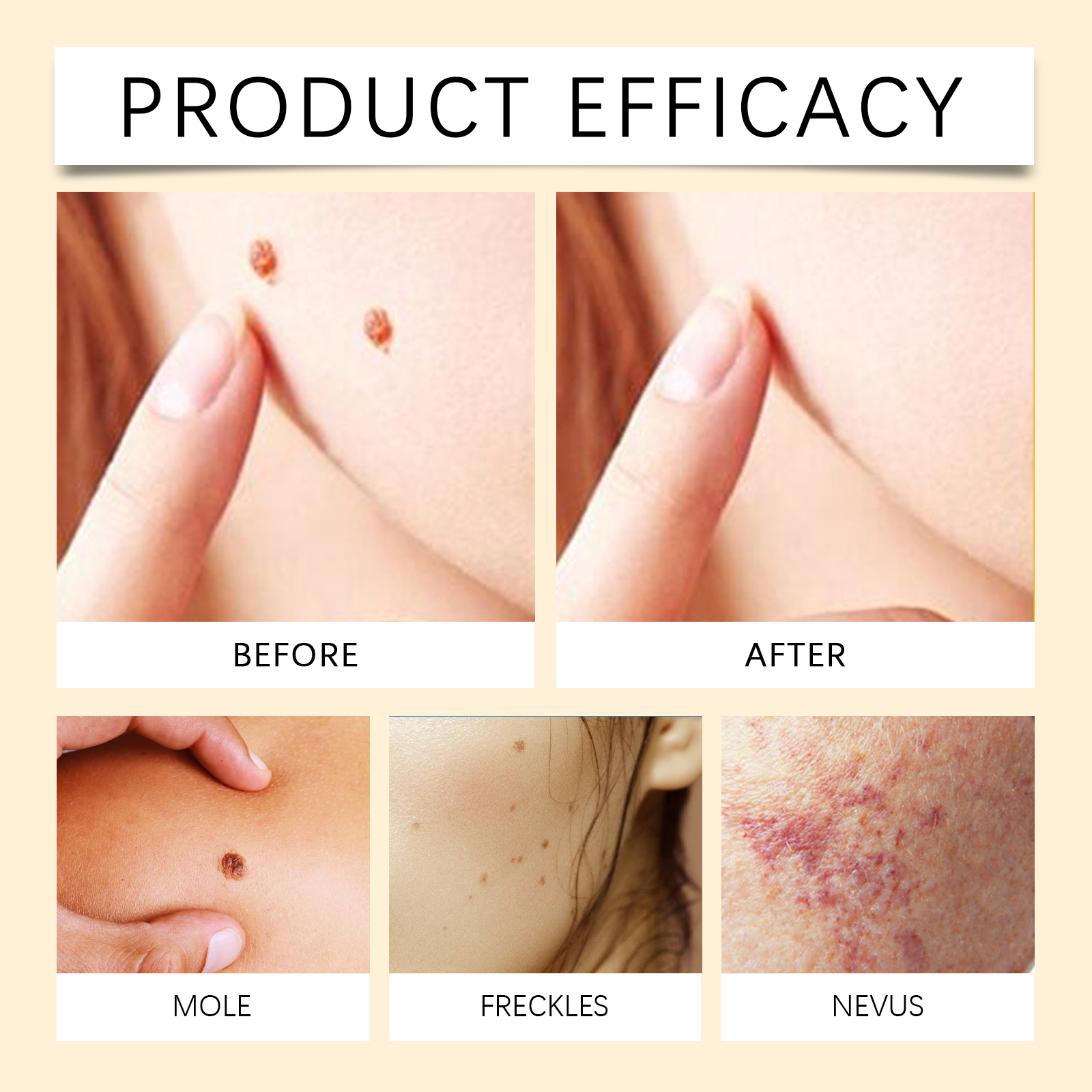 Bee Venum Skin Care Cream Mild Herbal Formula Soft Smooth Skin Daily Clearing Wart Removing Lotion Cream