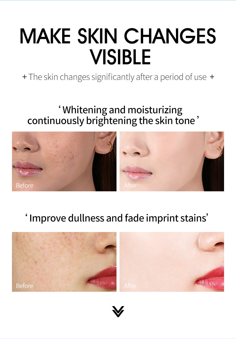 Whitening Freckle Cream Remove Melasma Cream Face Cream Remove Dark Spots Anti Wrinkle Moisturize Brighten Smooth Face Skin Care