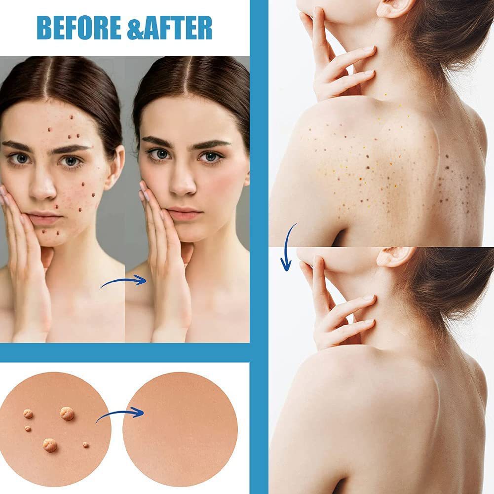 Skin Tag Patches Wart Patches for Mole and Wart Care Verruca and Filiform Removal Dots Stickers For Face And Skin