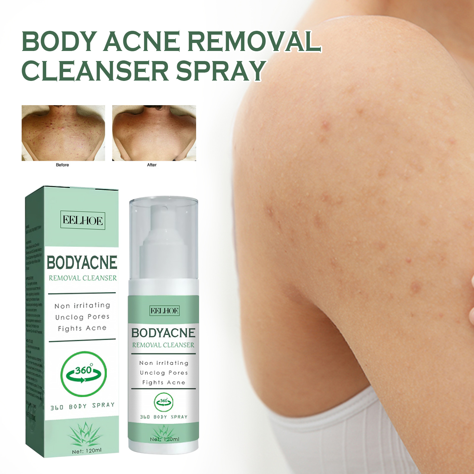 (1 PC) Body Acne Removal Cleanser Spray for Back and Arm Anti-acne Water Oil Balance Remove Redness Shrinking Pores Clean Body Pimple Remover Spray