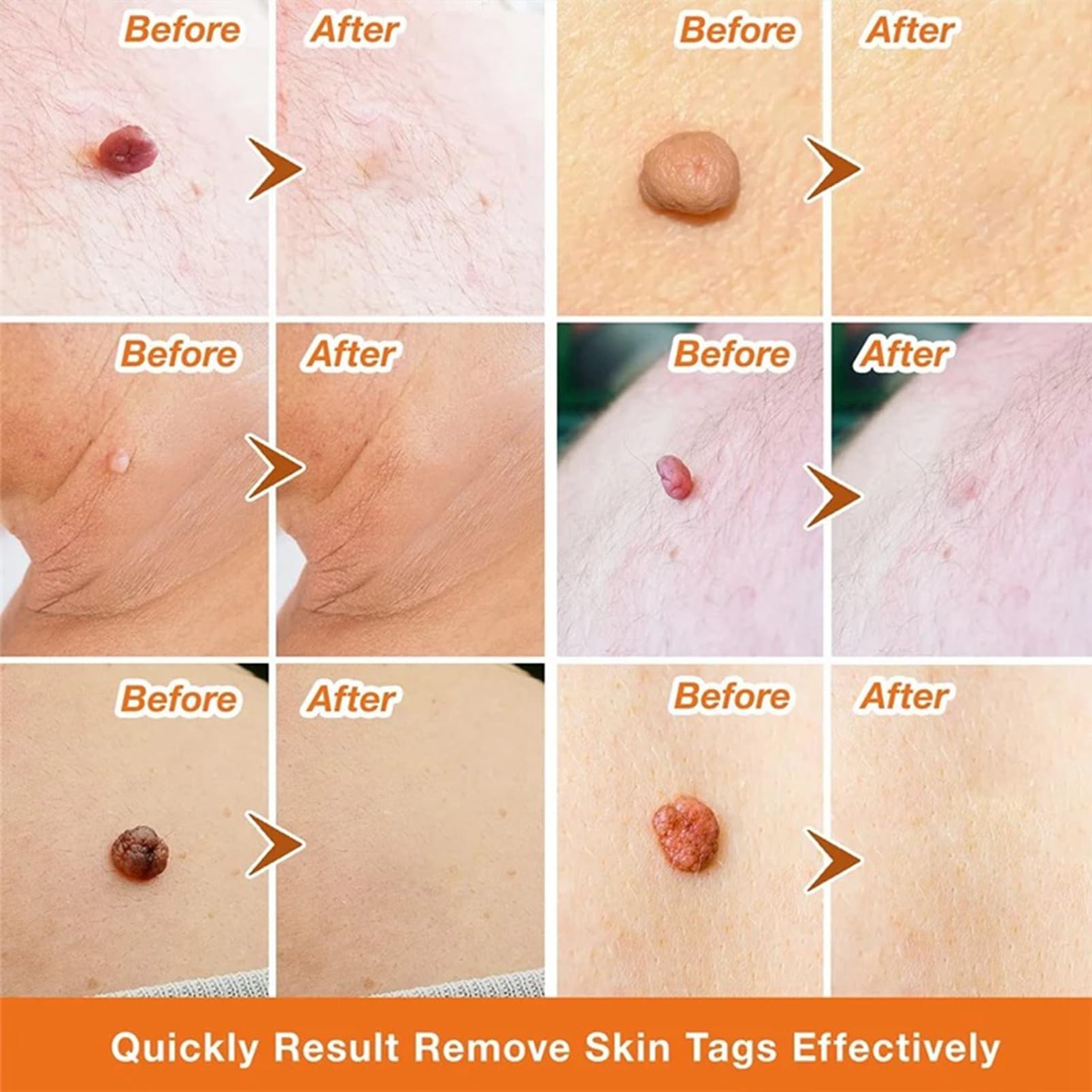 (1 pc) Skin Tag Remover Cream Painless Mole Skin Dark Spot Warts Remover Natural Skin Tag Mole Removal for Face and Body