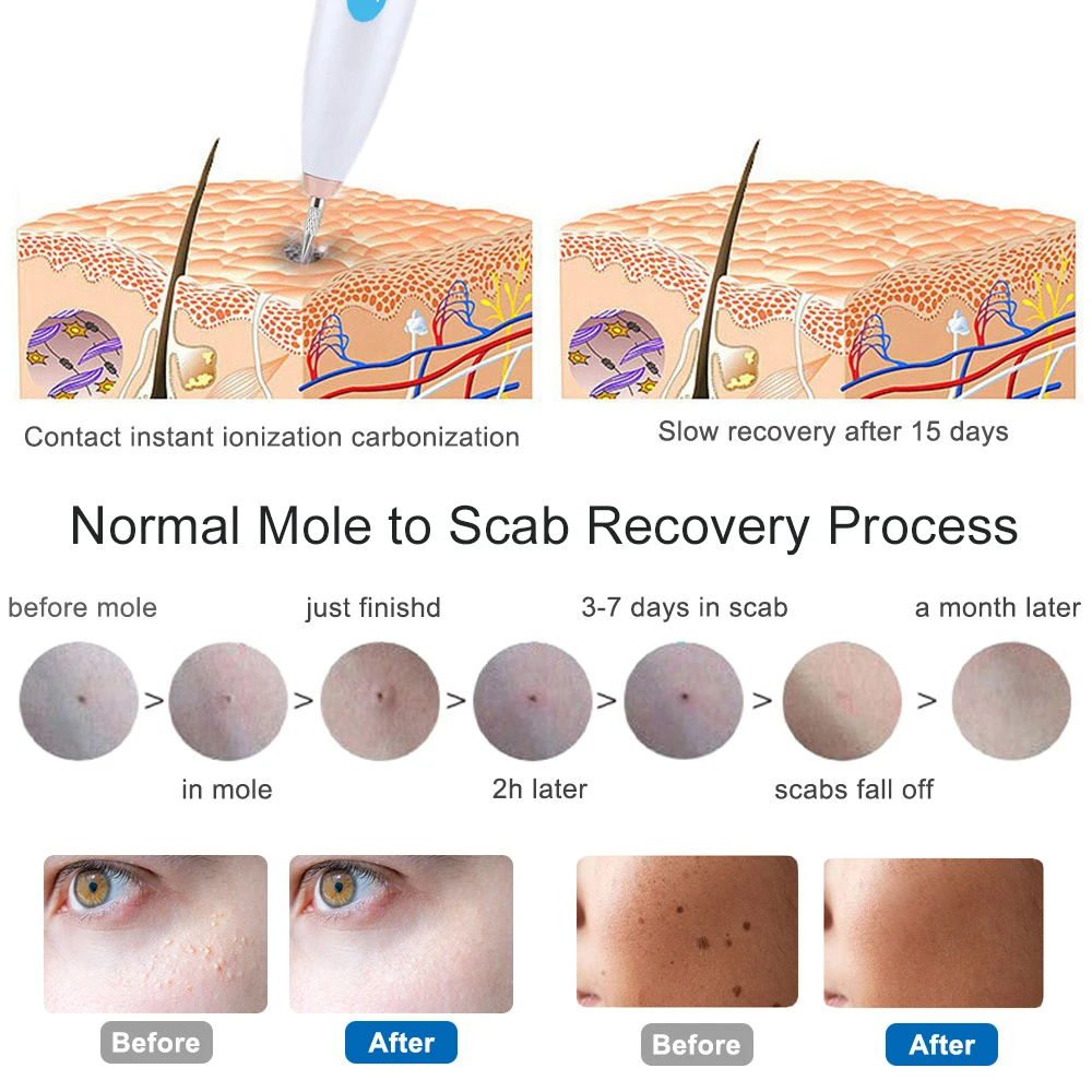 Mini Plasma Pen Freckle Remover Machine Laser Mole Removal Dark Spot Skin Wart Tag Remove Tattoo Removal Skin Care Beauty Tool Face Body 9 Mode LCD