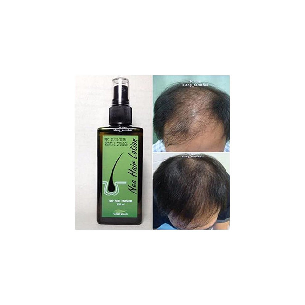 Hot Seller Neo Hair Lotion Herbs 100 Natural Treatment Spray Stop Hair Loss Root Nutrie