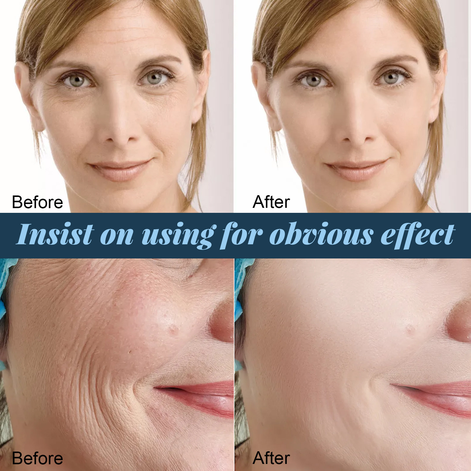 Protein Thread Lifting Face Filler Protein Line Hydrolyzed Collagen Absorbable Smoothing Firming Moisturizing Tightening Anti-wrinkle