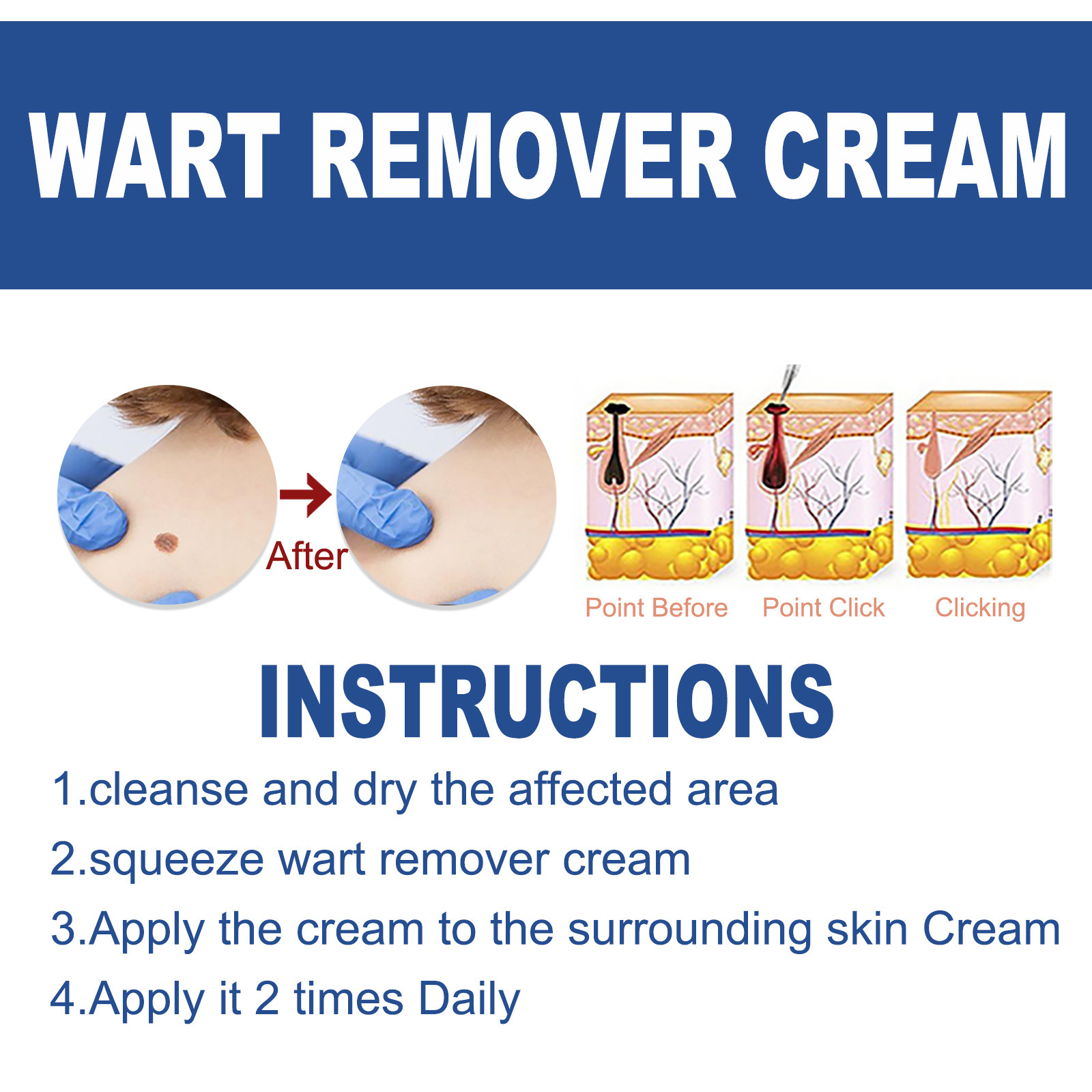 South Moon Skin Tag Remover Liquid Kit Wart and Tag Remover Wart Remover Fast Acting and Painless  for Body Anti Acne Face Cream Natural Safe Mole Remover