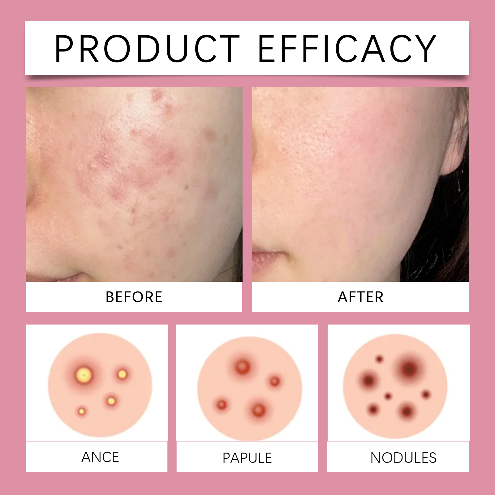 Skin Care Patch Gentle Nurture Facial Body Skin Clean Acne Care Breathable Material Skin Friendly Patch