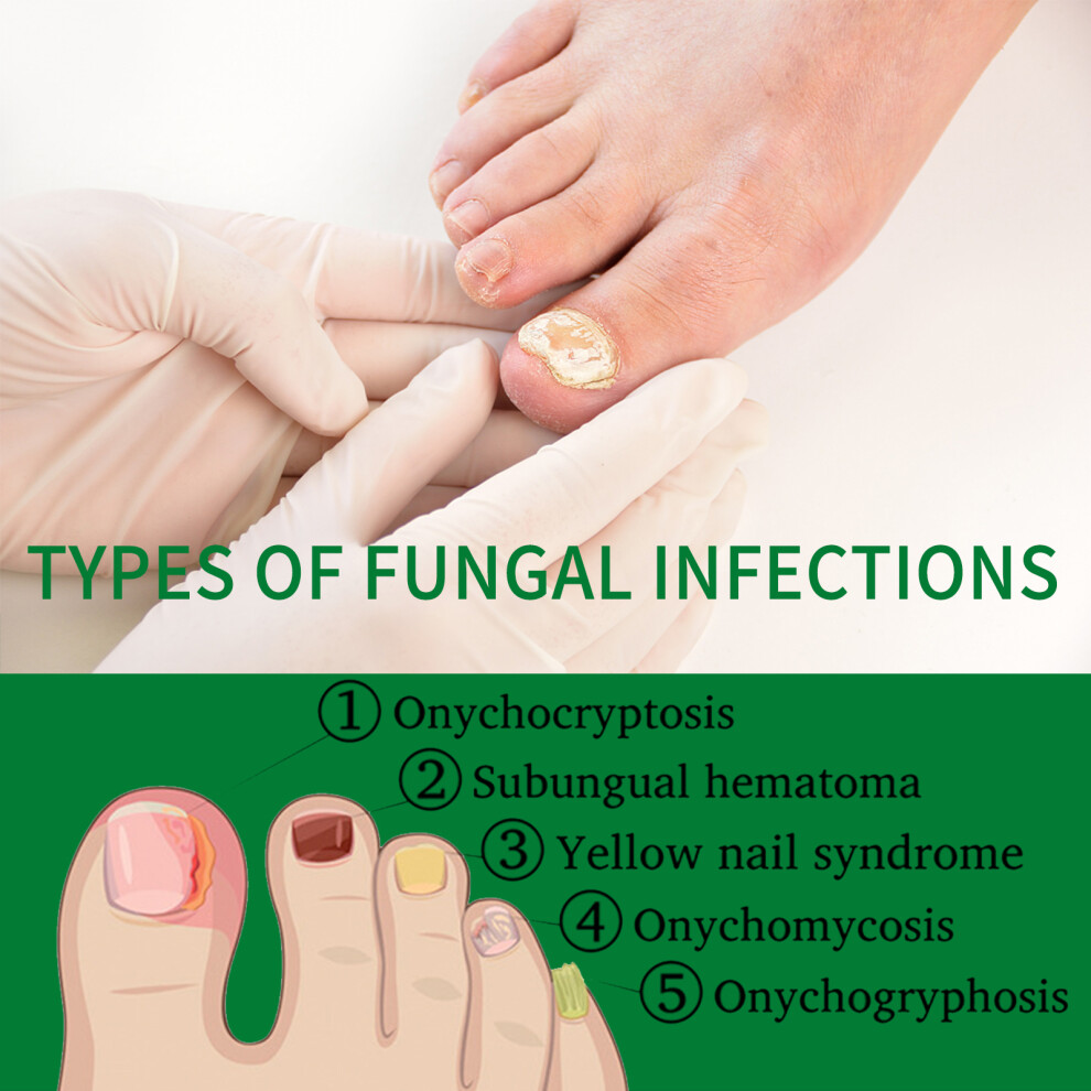 Nail Fungus Treatment Ginger Extract Nourishing Liquid for Hand Foot Nails 30ml