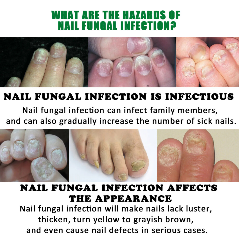 Nail Fungus Treatment Ginger Extract Nourishing Liquid for Hand Foot Nails 30ml