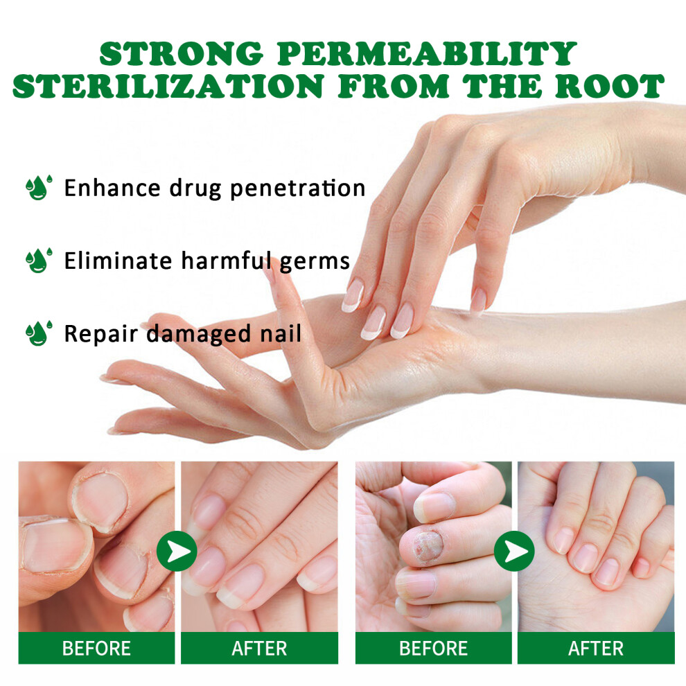 Nail Fungus Treatment Ginger Extract Nourishing Liquid for Hand Foot Nails 30ml