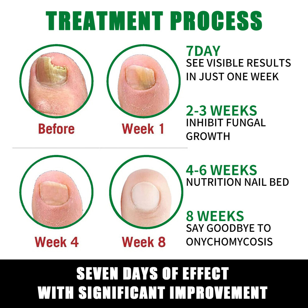 Nail Fungus Treatment Ginger Extract Nourishing Liquid for Hand Foot Nails 30ml
