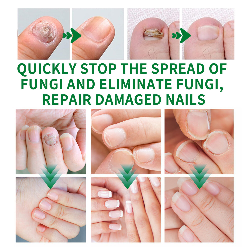 Nail Fungus Treatment Ginger Extract Nourishing Liquid for Hand Foot Nails 30ml