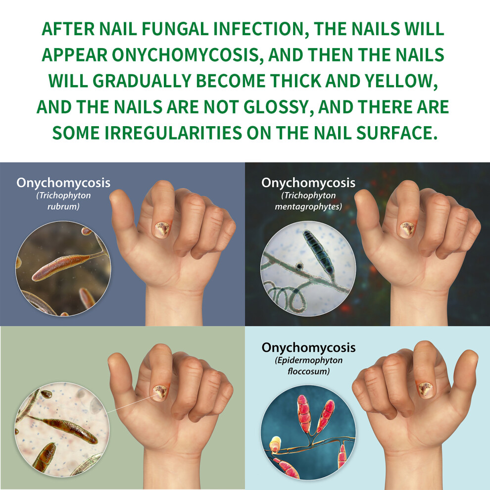 Nail Fungus Treatment Ginger Extract Nourishing Liquid for Hand Foot Nails 30ml