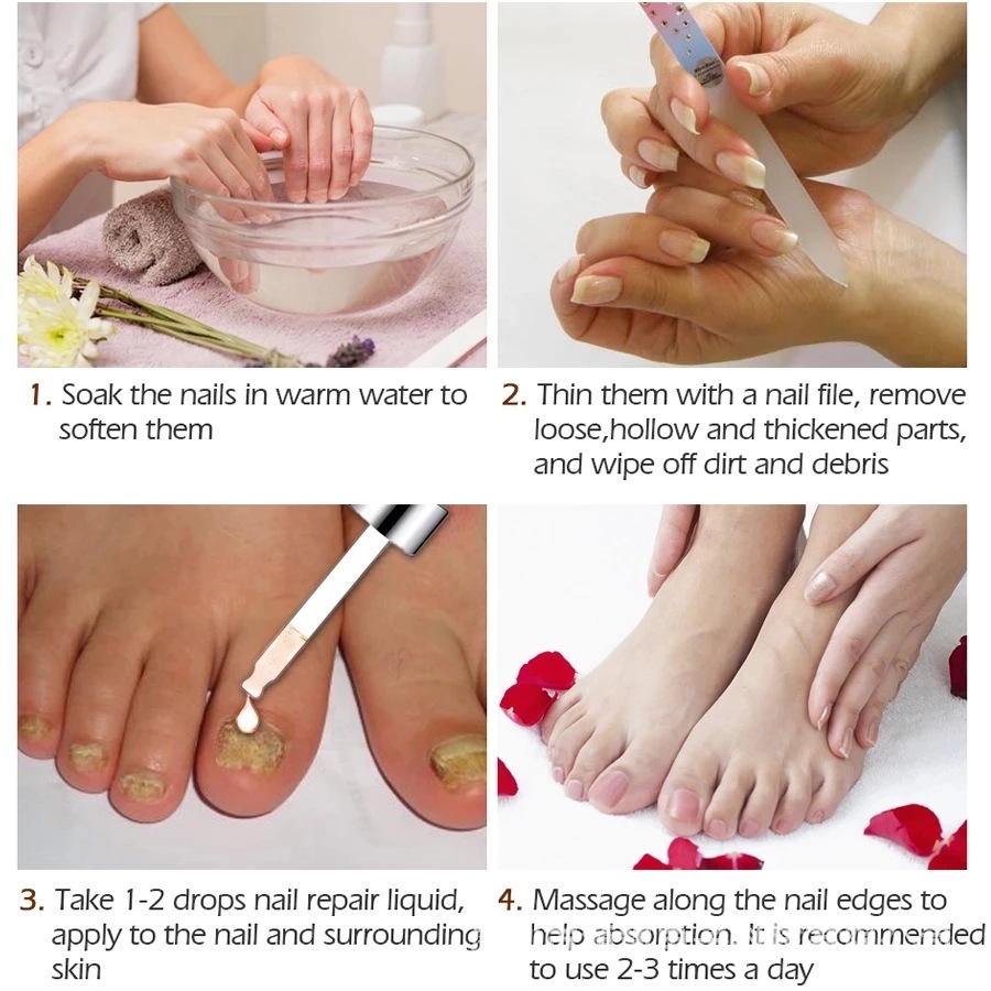 SUAI Nail Fungus Treatment Repair Liquid Foot Essence Serum Feet Care Products Anti Infection Onychomycosis Paronychia 20ml