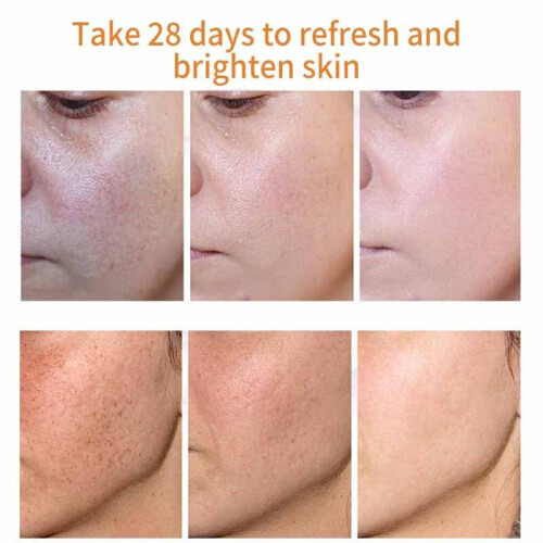 Whitening Freckle Cream Remove Melasma Acne Dark Spot Skin Care 20ml