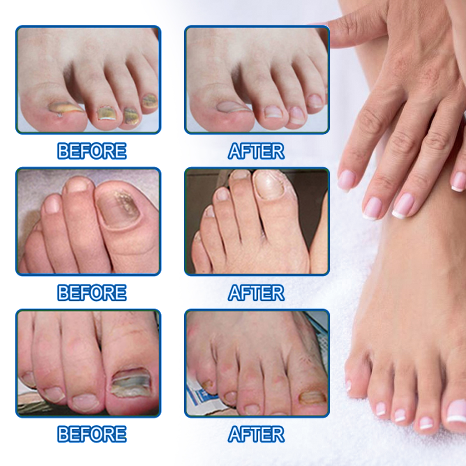 Nail Repair Patch For Soft Ingrown Thickened Nails Overnight Moisturizing Care For Toenails And Fingernails Daily Home Treatment