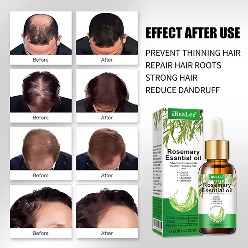 iBeaLee Rosemary Essential Oil for Hair Growth Reduce Hair Loss Hair Treatment Deeply Nourishing 20ml