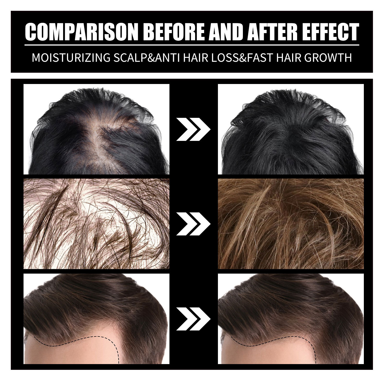 Biotin Oil Fast Hair Regrowth Serum Hair Essential Oil Hair Thinning Treatment Liquid Anti-hair Loss For Women Men 30ml