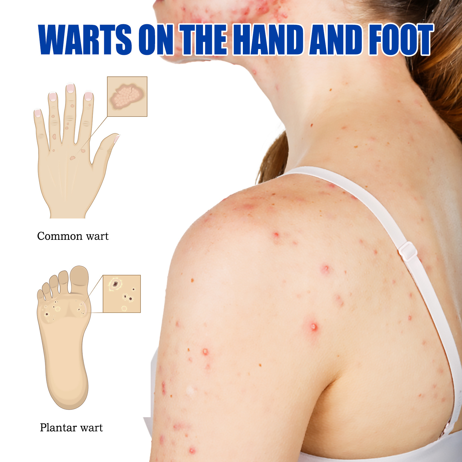 Ouhoe Skin Tag Remover Warts Remover Ointment Mole Remover Cream Mole Corrector Safe Painless Remove Skin Tag Callus Skin Treatment Ointmen
