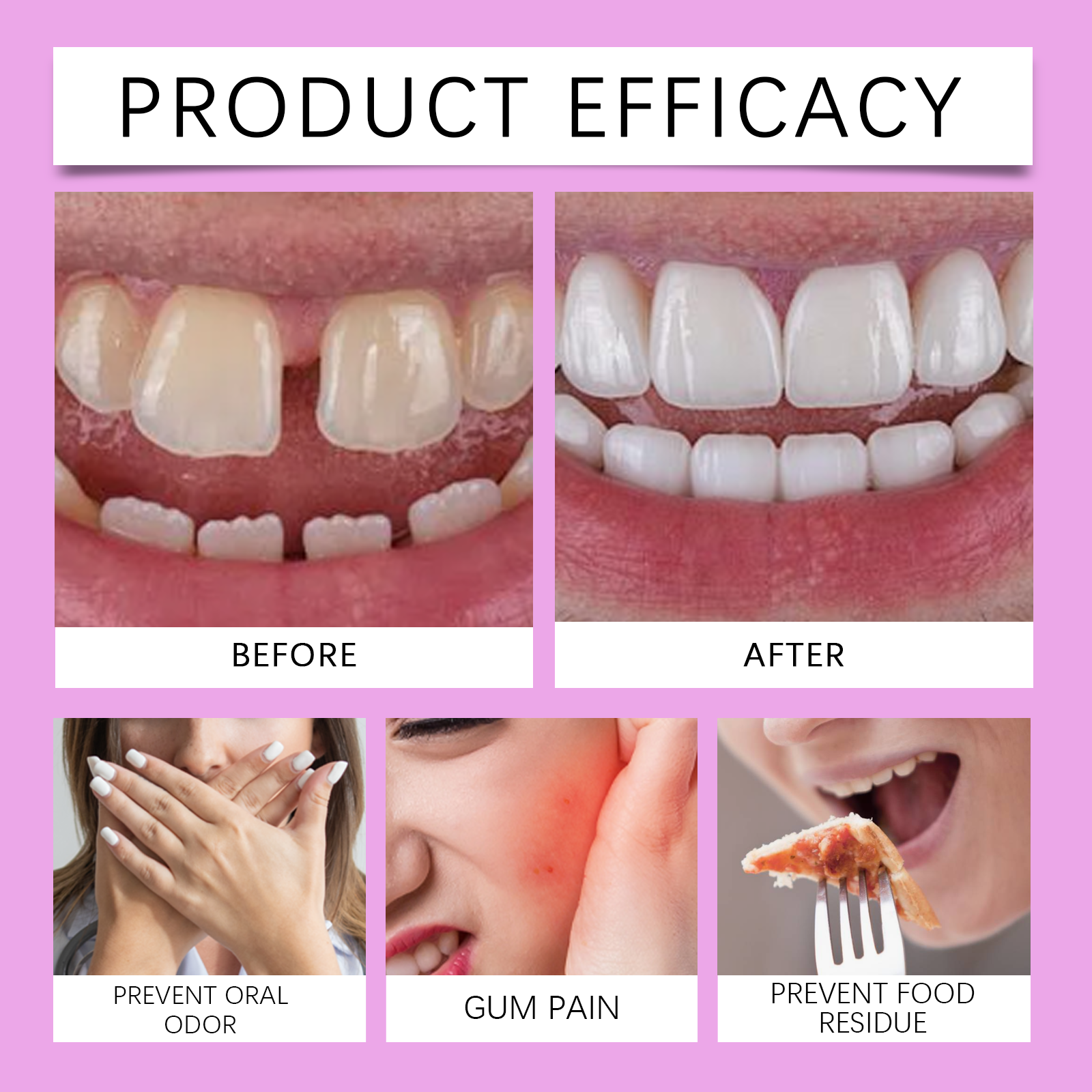 Denture Adhesive Thermoplastic Material To Secure Dentures And Boost Daily Wearing Comfort Feeling
