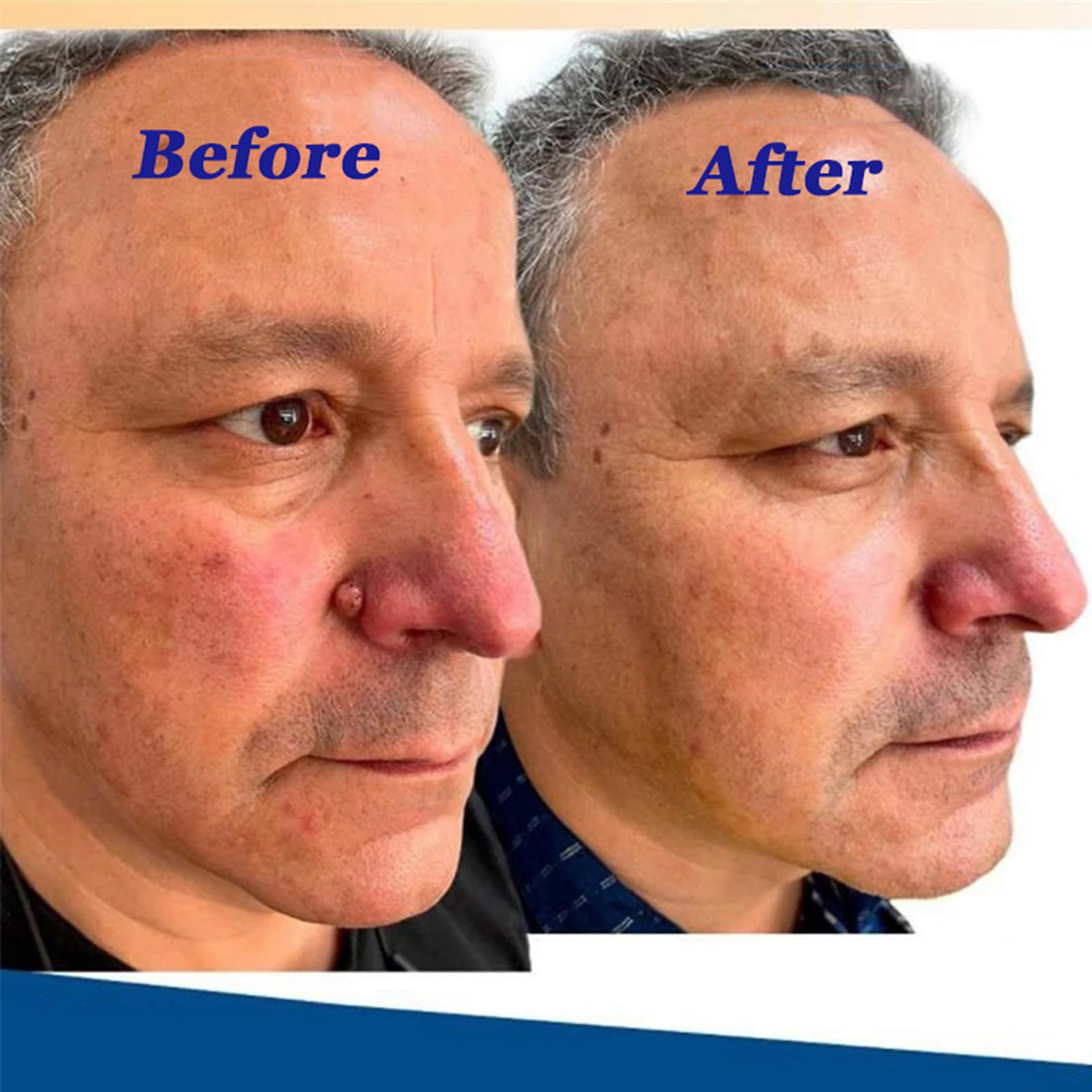 (1 pc) Skin Tag Remover Cream Painless Mole Skin Dark Spot Warts Remover Natural Skin Tag Mole Removal for Face and Body