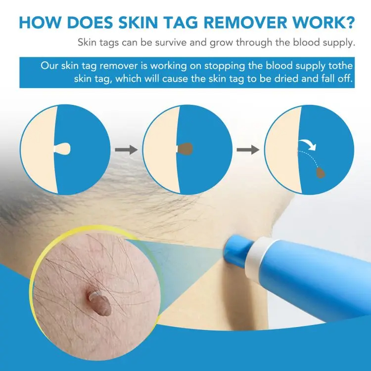 Skin Tag Removal Tool Dual Head Wart Removal Kit Flat Plantar Wart Remover Wart Wart Liquid Pen Flesh Mole Remover Chicken Eye Wart Remover Face Beauty