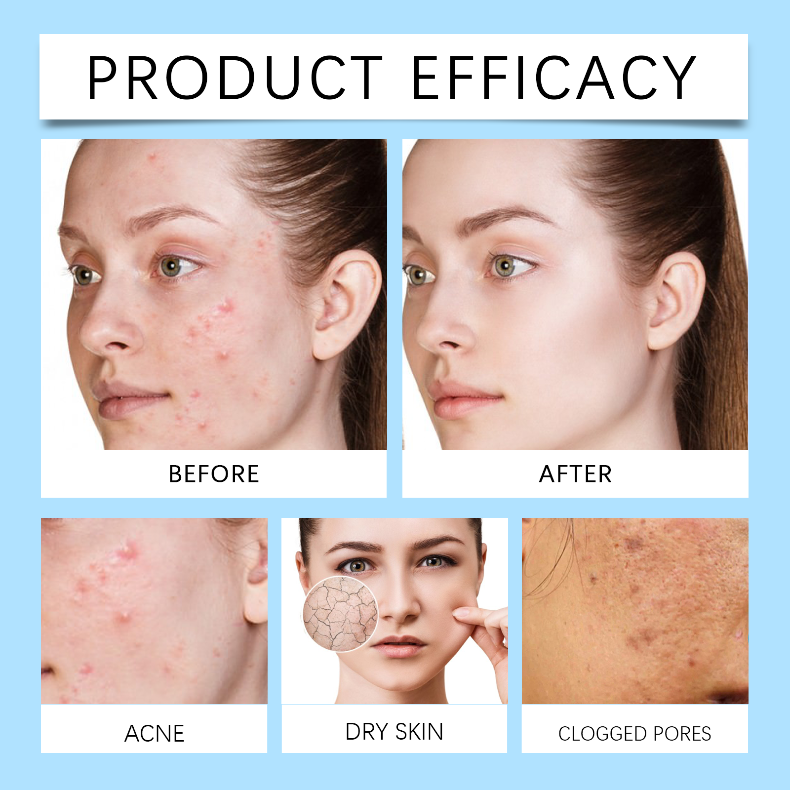 Facial Cream Mild Nourish Acne Moist Hydrate Refreshing Smooth Soften Daily Care