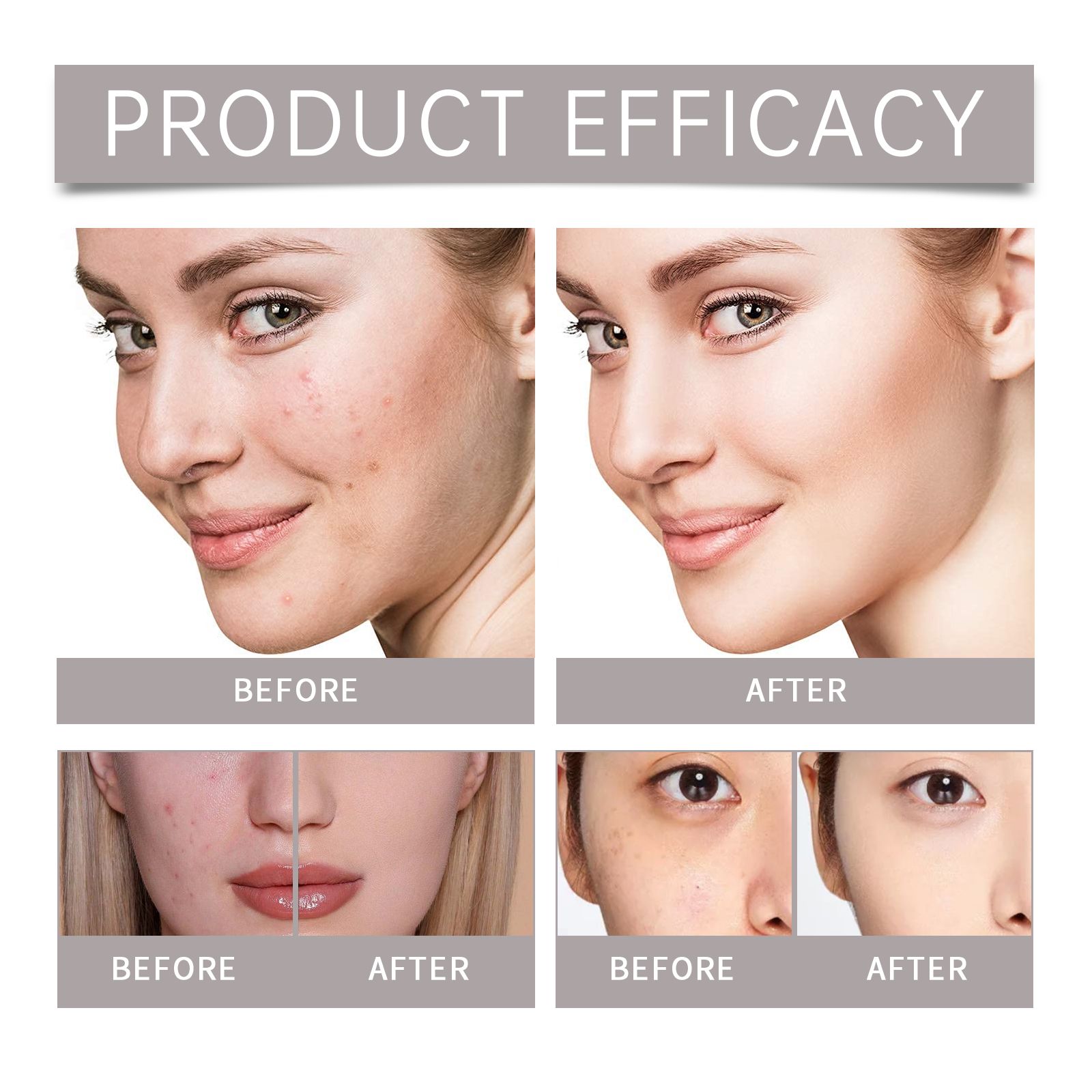 Blemish Care Set With Niacinamide Hyaluronic Acid And AHA BHA Serum For Acne Prone Skin