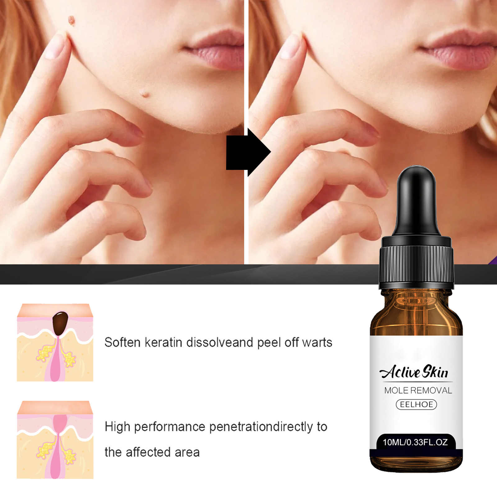 EELHOE Aclive Skin Mole Removal Essence