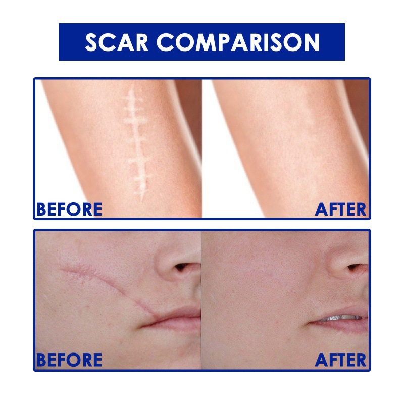 Scar Care Balm For Smoothing Moisturizing And Soothing Skin Daily Comfort Treatment For Burns Cuts And Surgical Scars