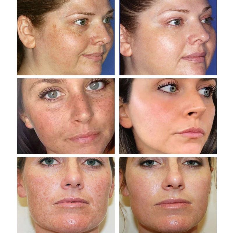 iBeaLee Whitening Freckle Cream Remove Melasma Dark Spots Cream Anti-Aging 20ml