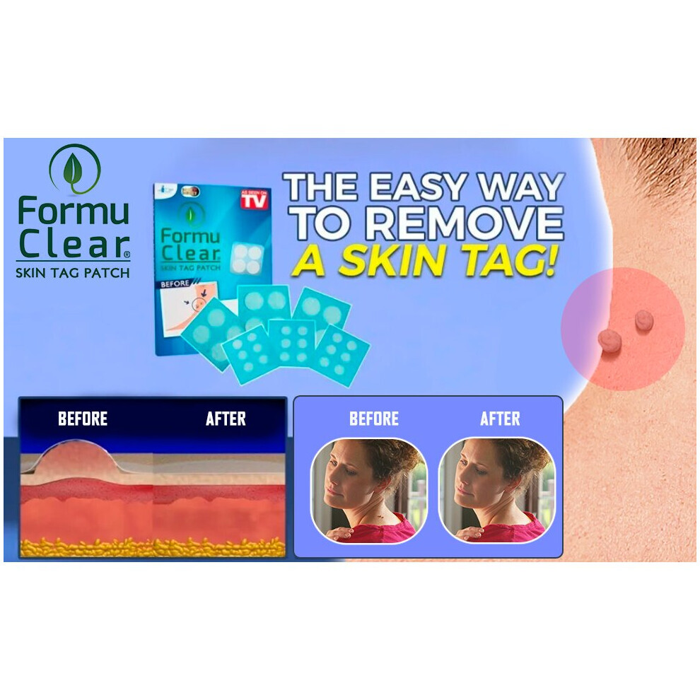Skin Tag Remover FORMUCLEAR Skin Tag As seen on TV Patch Remover 30 Natural Bands Removal Against Skin Tag With Salicylic Formulation Natural Painless Treatement