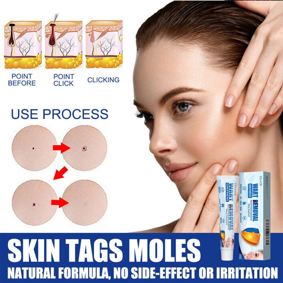 Wart Remover Cream 20g Fast Acting Gel Wart ACare Ointment for Face Hands Feet Body