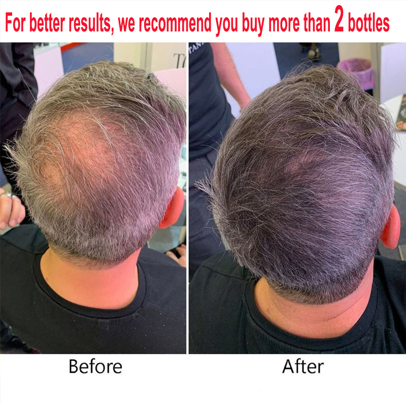 Hair Growth Essential Oil Ginger Hair Lost Solution Serums Fast Scalp Hair Care Treatment For Men Women 20ml