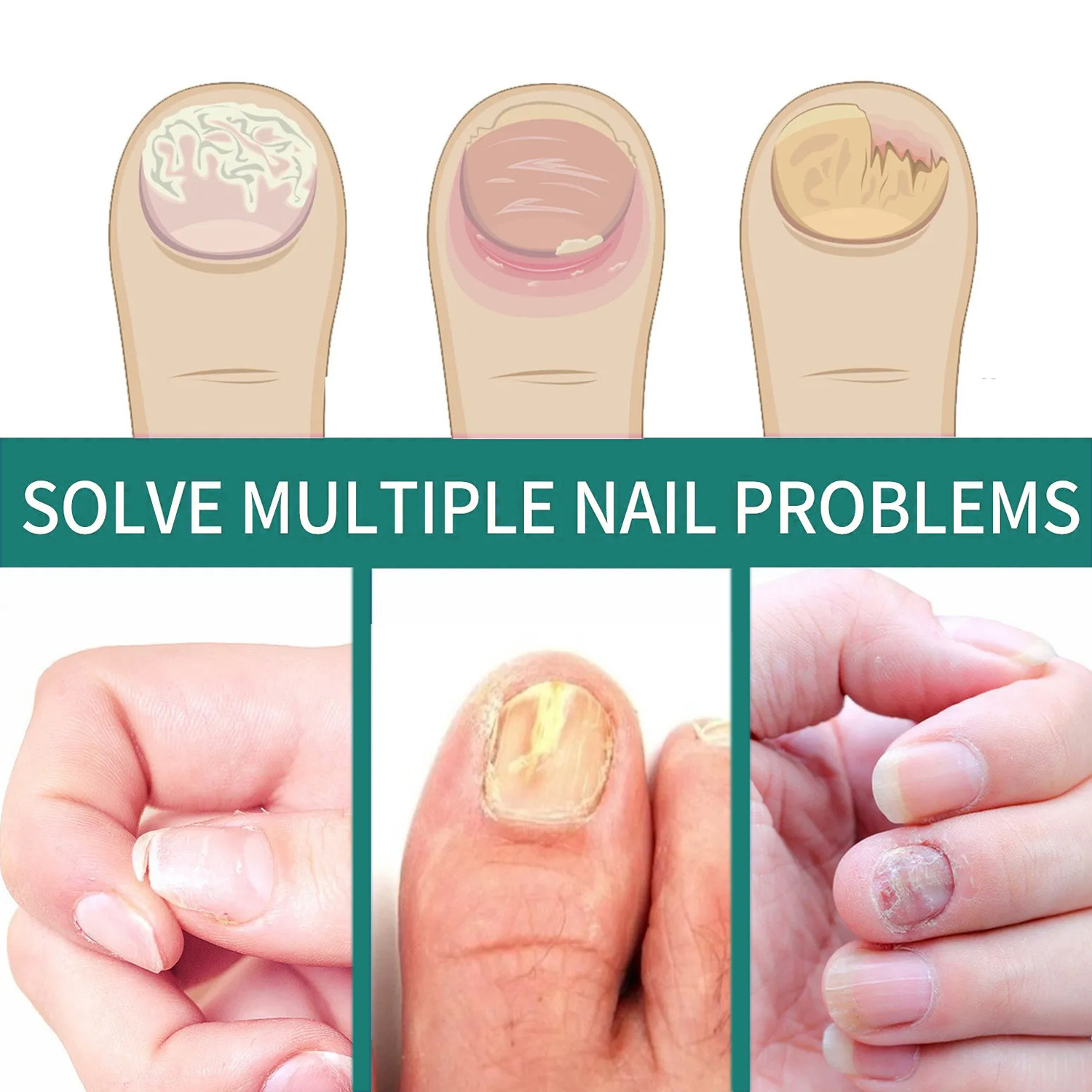 Toenail Fungus Treatment Nail Fungal Renewal Solution Nail Repair Liquid Nail Care 20ml