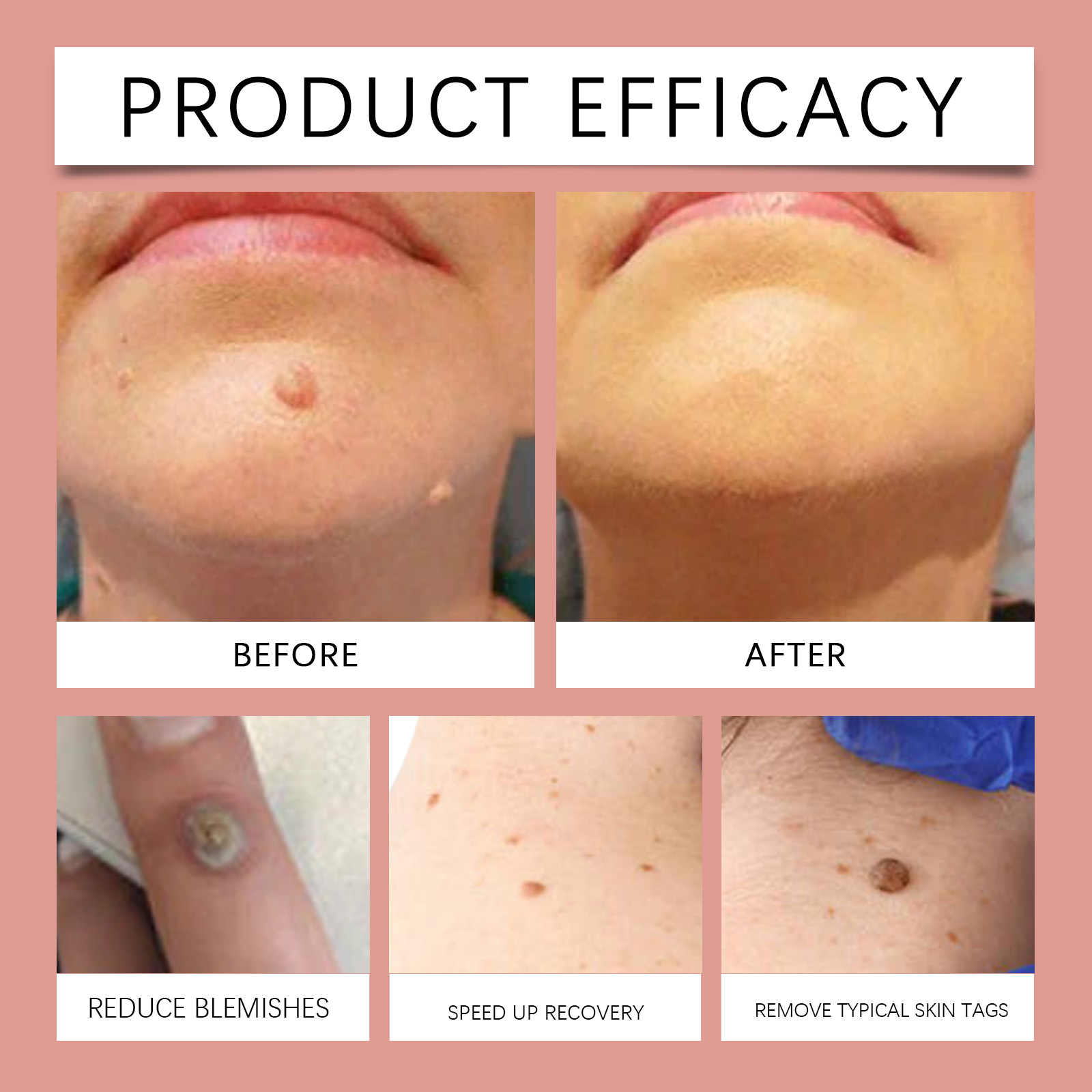 Skin Patch For Acne And Wart Waterproof Ultra Thin Invisible Clear Round Hydrocolloid Skin Cleansing Care