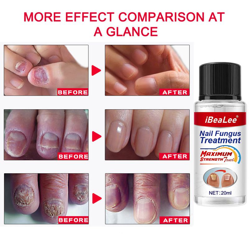 iBeaLee Nail Fungus Treatment Natural Safe And Effective Nail Repair Liquid