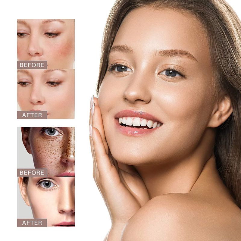 iBeaLee Skin Whitening Freckle Cream Melanin Fade Brighten Lightening Skin Care Facial