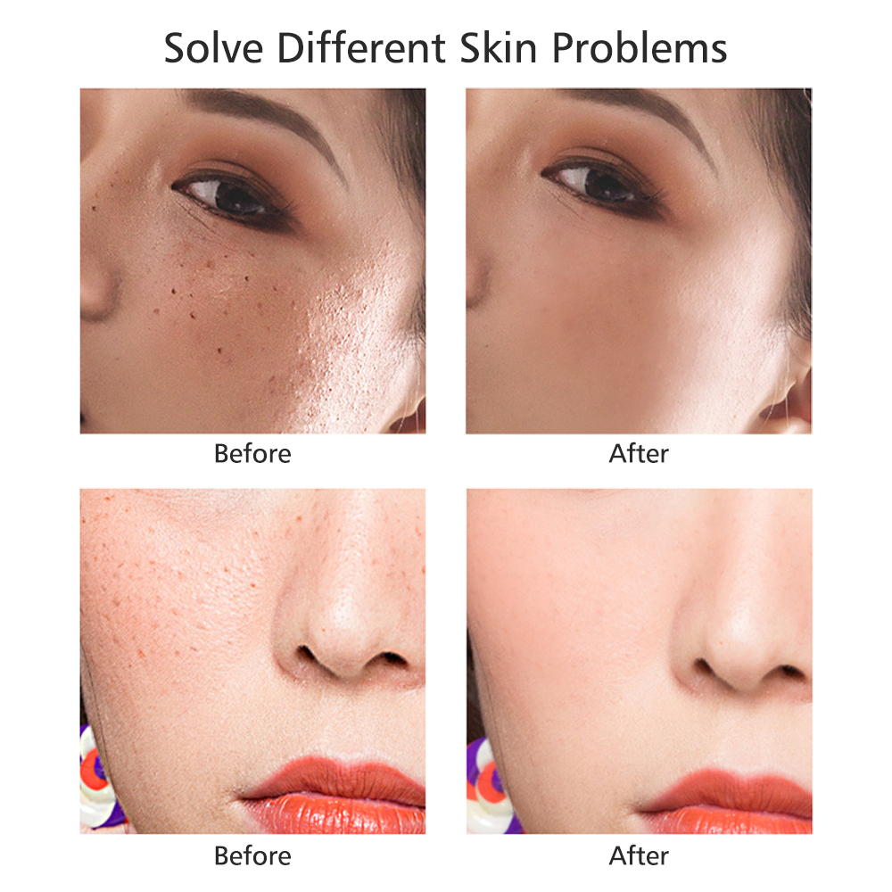 Laser Tattoo Freckle Remover Mole Skin Tag Removal Machine Dark Spot Remover Tool Face Care Skin Beauty Mini Laser Plasma Pen Portable.