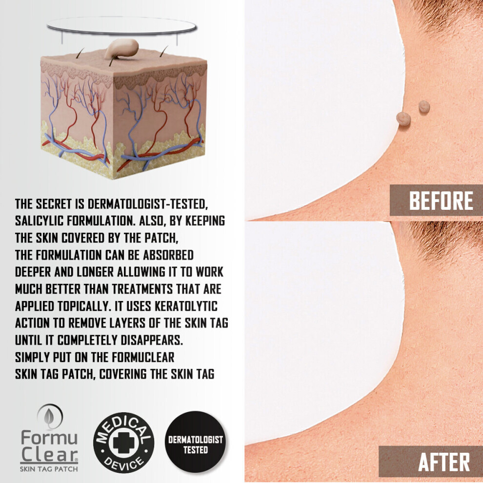 Skin Tag Remover FORMUCLEAR Skin Tag As seen on TV Patch Remover 30 Natural Bands Removal Against Skin Tag With Salicylic Formulation Natural Painless Treatement