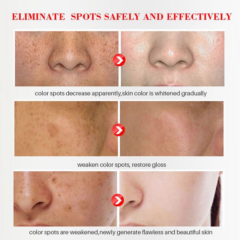 iBeaLee Whitening Freckle Cream Remove Melasma Dark Spots Cream Anti-Aging 20ml