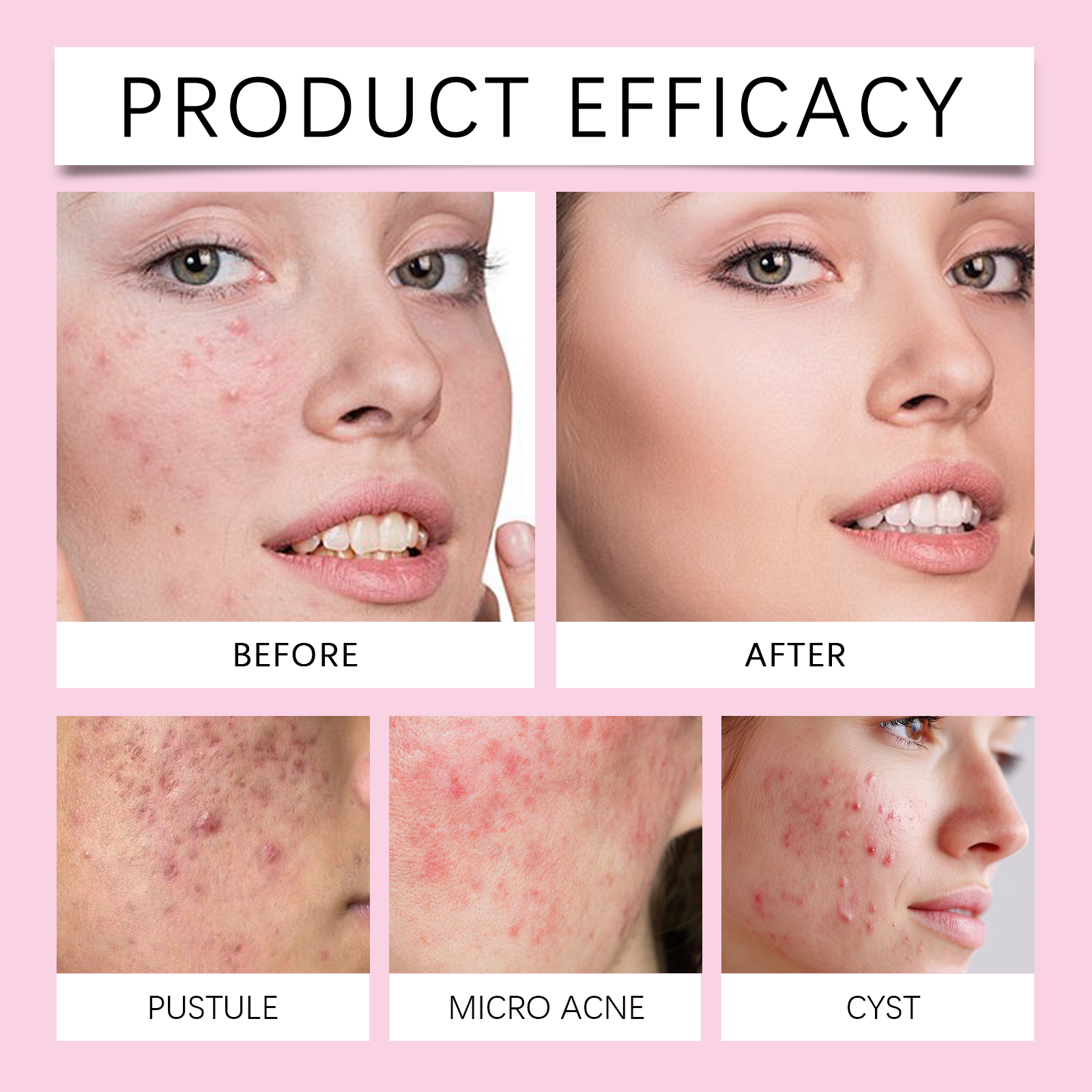 Cloud Acne Patch Mild Clean Thin Invisible Skin Friendly Smooth Soft Facial Surface Pimple Care