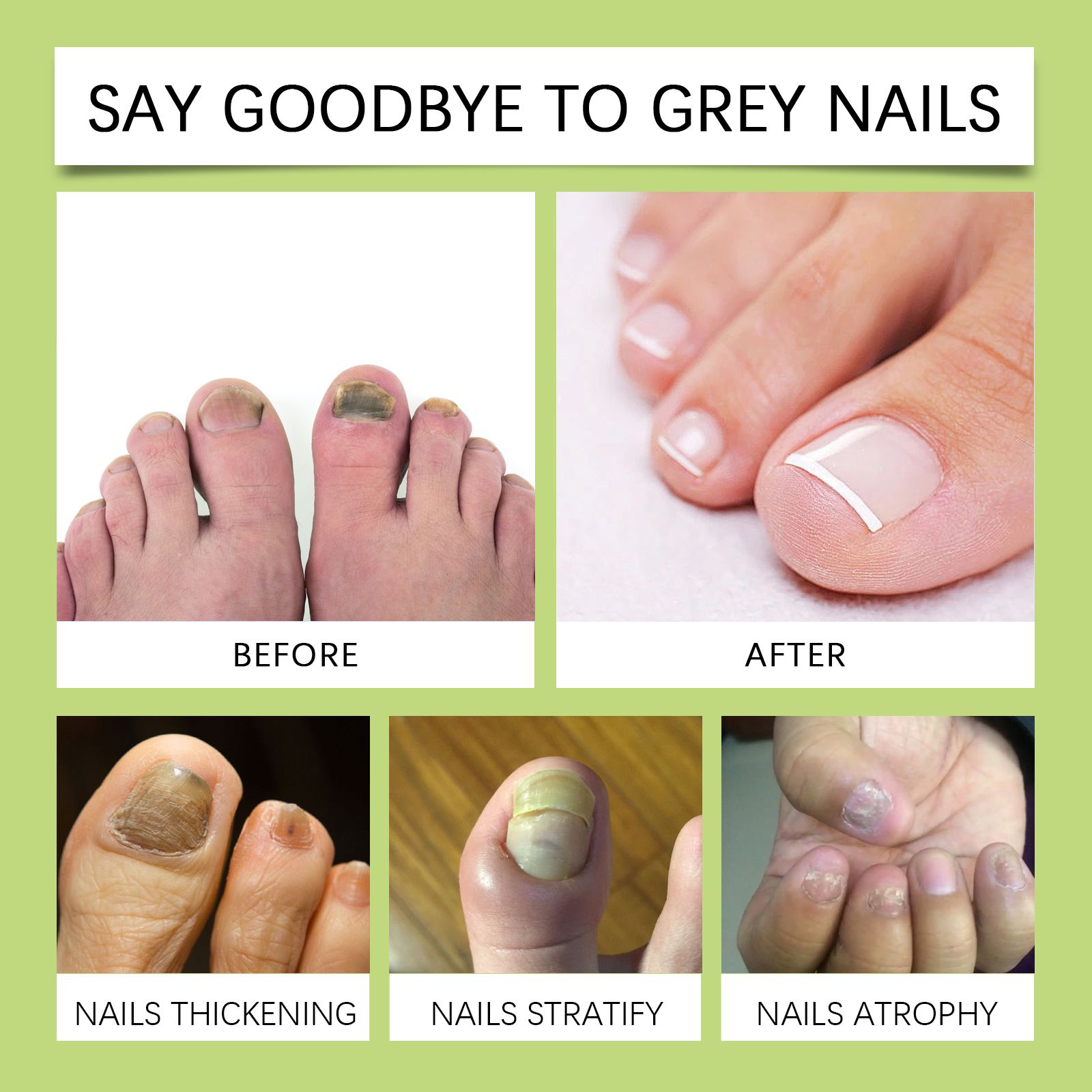 Nail Care Essence For Toenails And Fingernails Gentle Cleansing Moisturizing Repair Daily Home Treatment 15ml