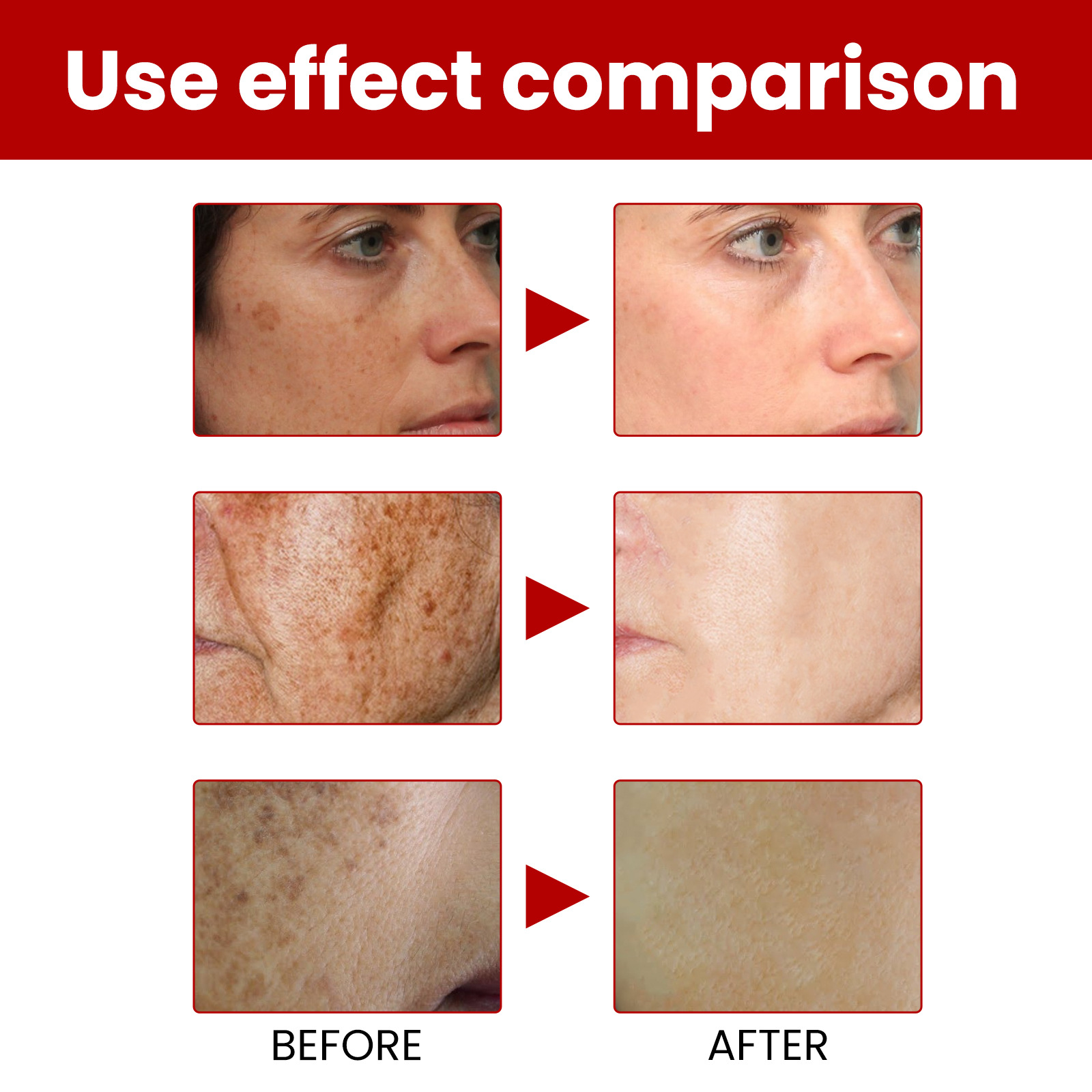 Whitening and Freckle Removing Cream Remove  Dark Spot Melanin Melasma Lighten Brighten Smooth Skin Care