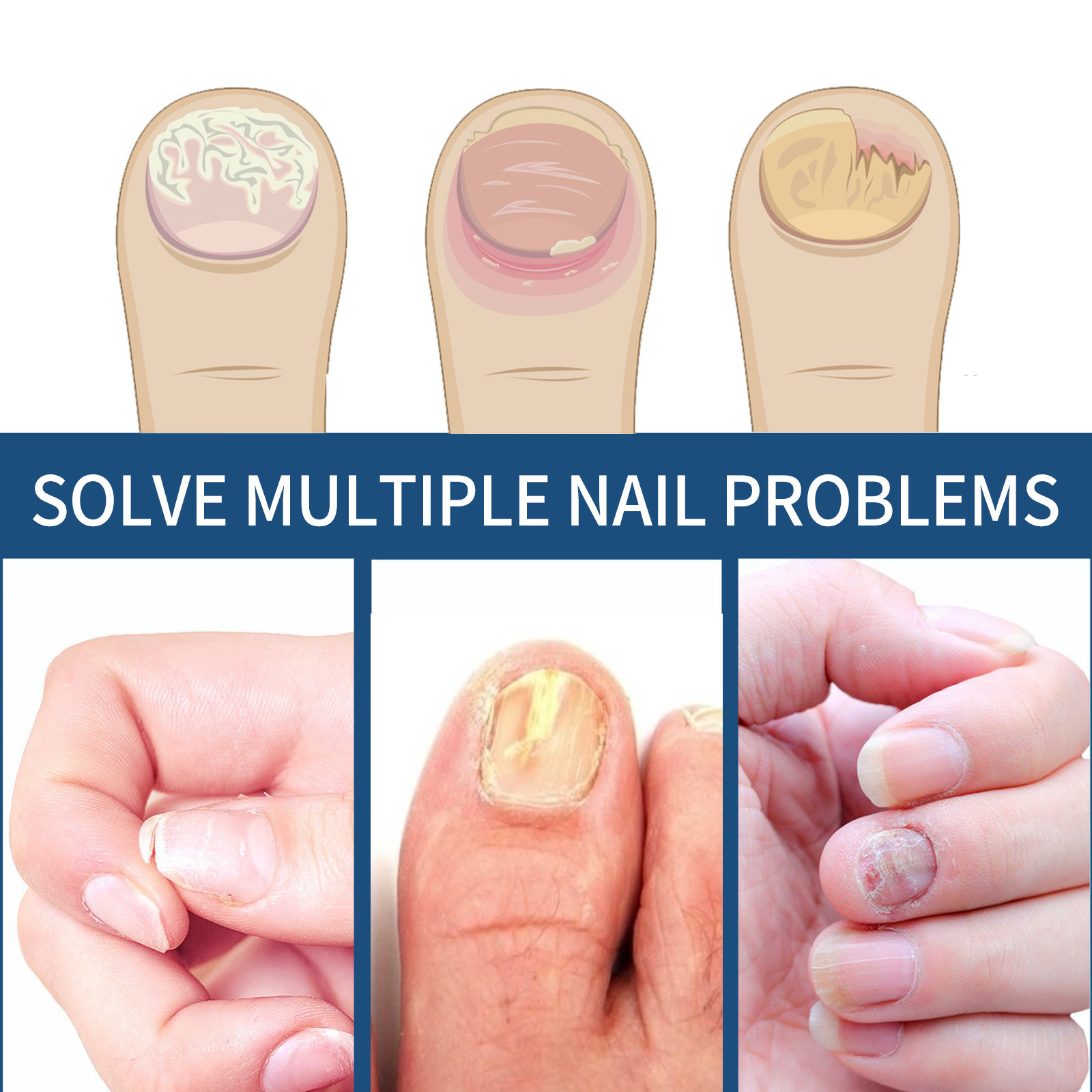 Toenail Care Patch For Soft Ingrown Thickened Nails Daily Nail Hygiene And Comfort Support