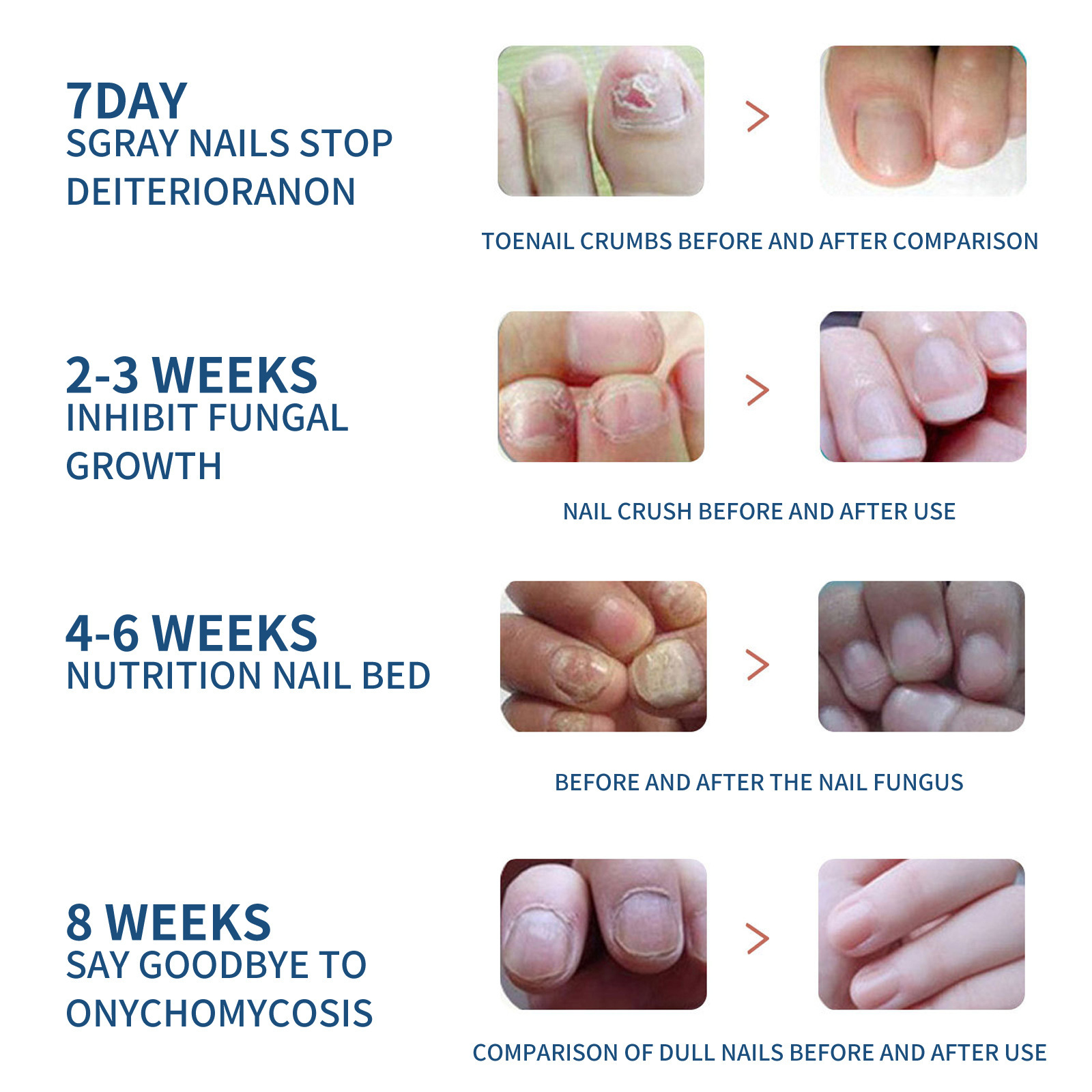 Toenail Care Patch For Soft Ingrown Thickened Nails Daily Nail Hygiene And Comfort Support