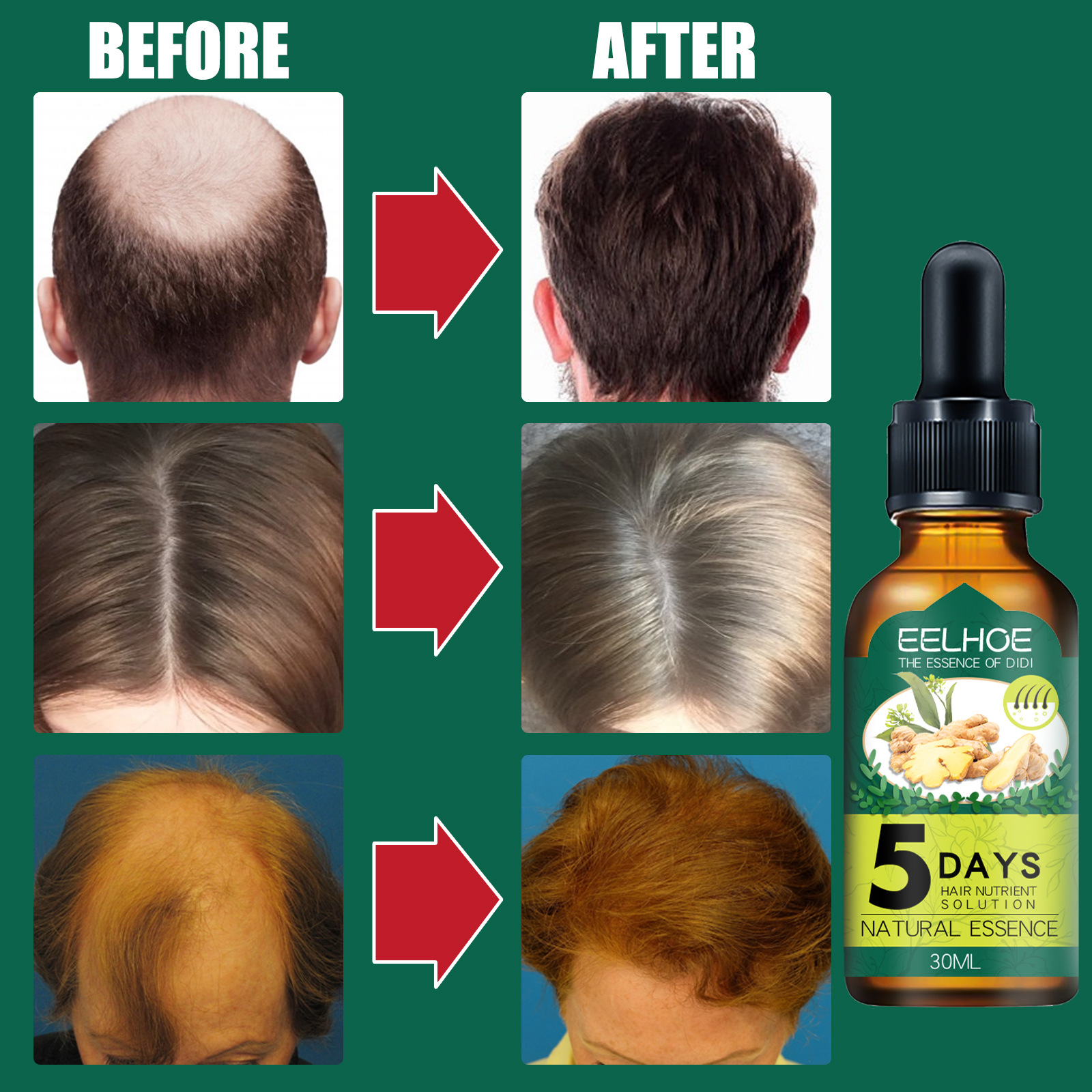 Ginger Hair Care Essential Oil Hair Growth Liquid Anti Hair Loss Serum 5 Days Nutural Solution Treat 30ml