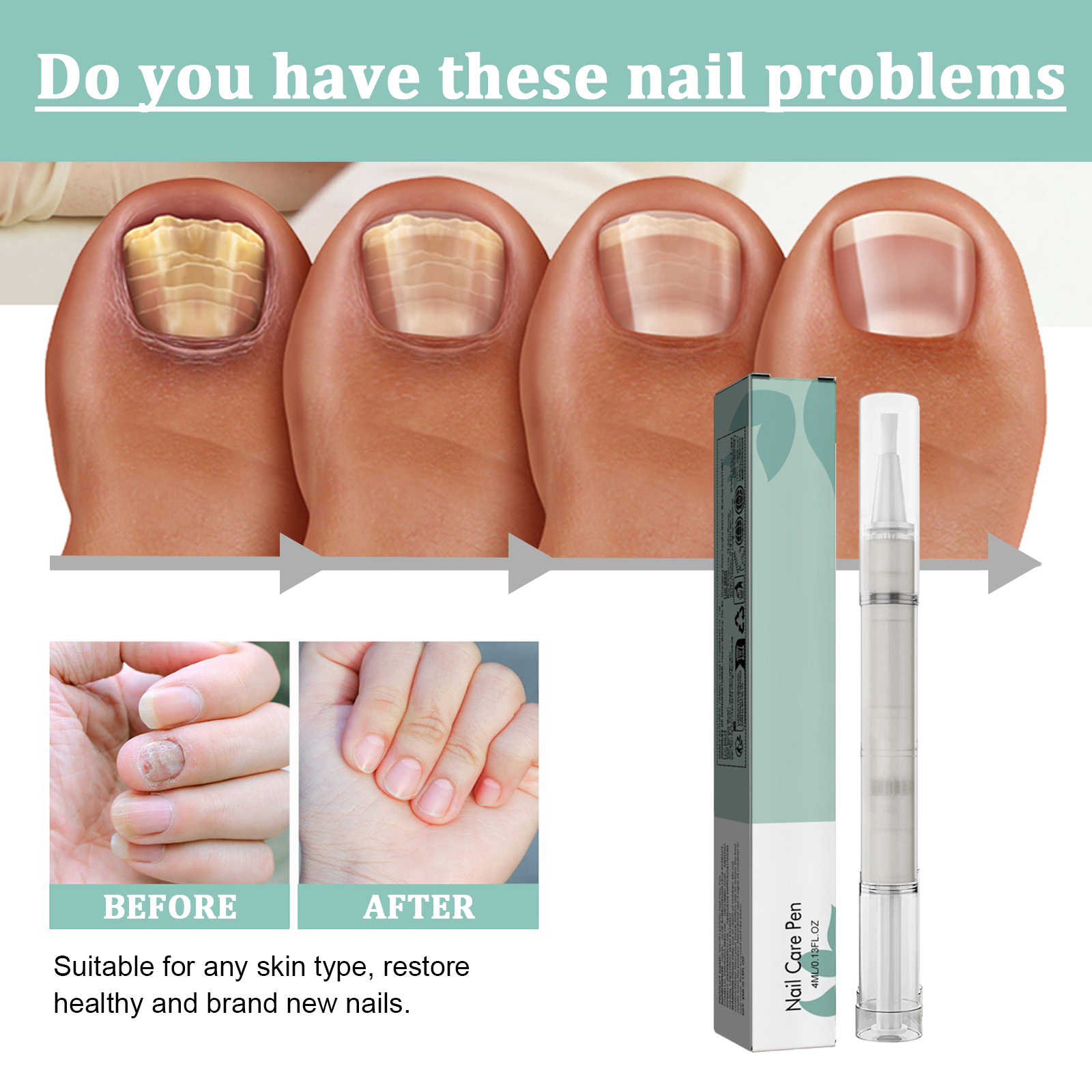 Nail Care Pen Cleansing Brightening Onychomycosis Care Liquid Thickened Onychomycosis Daily Care Tool