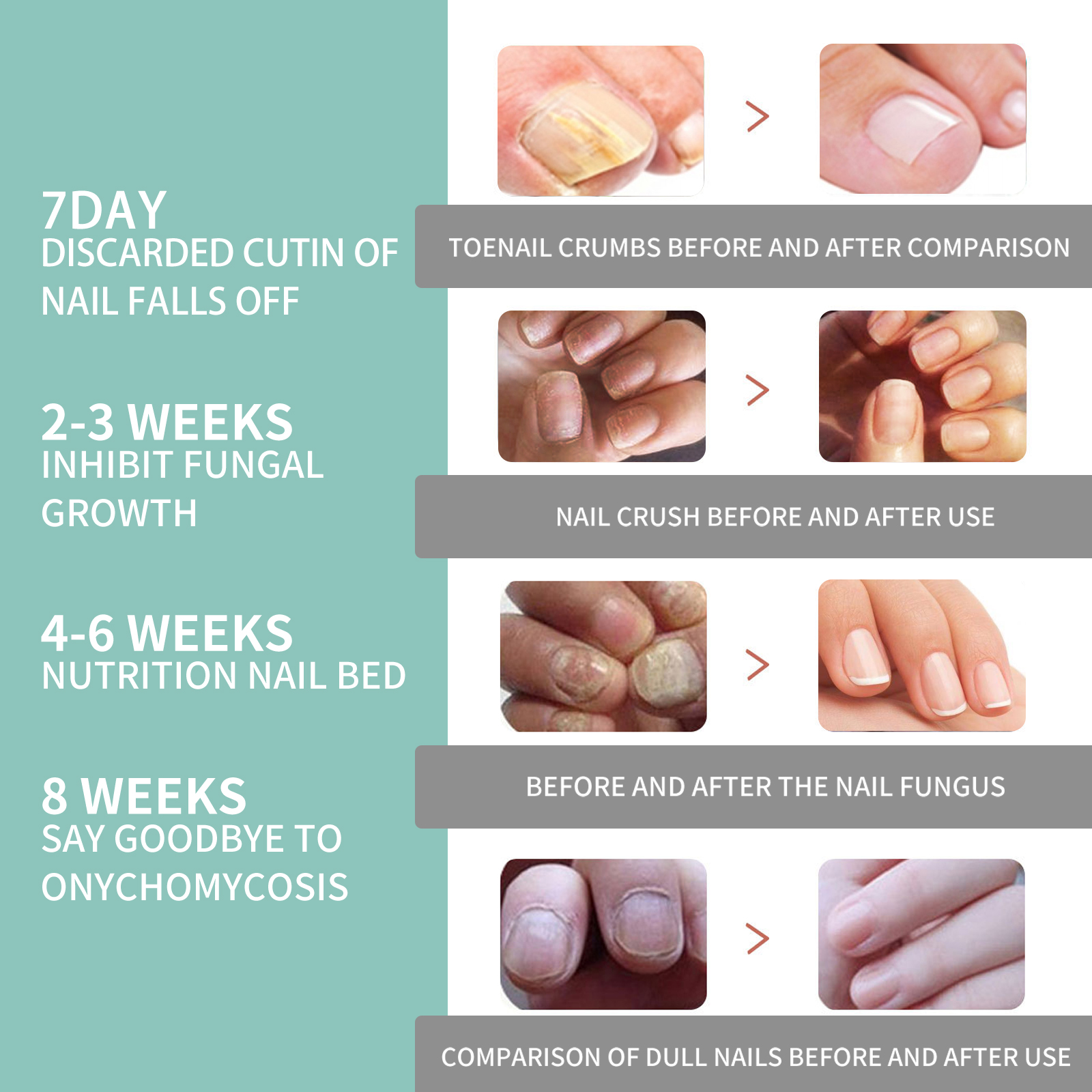 Nail Care Pen Cleansing Brightening Onychomycosis Care Liquid Thickened Onychomycosis Daily Care Tool