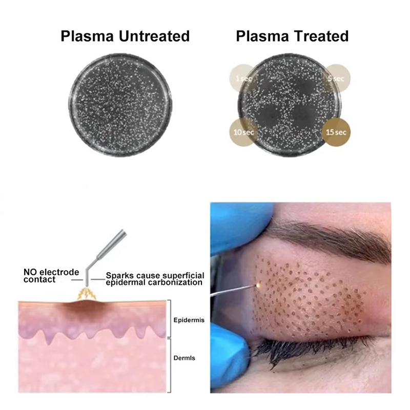 Laser Plasma Pen Black Dots Mole Wart Remover Pen Dark Spot Remover For Face Body Blemish Removal Laser Pen Skin Tag Removal