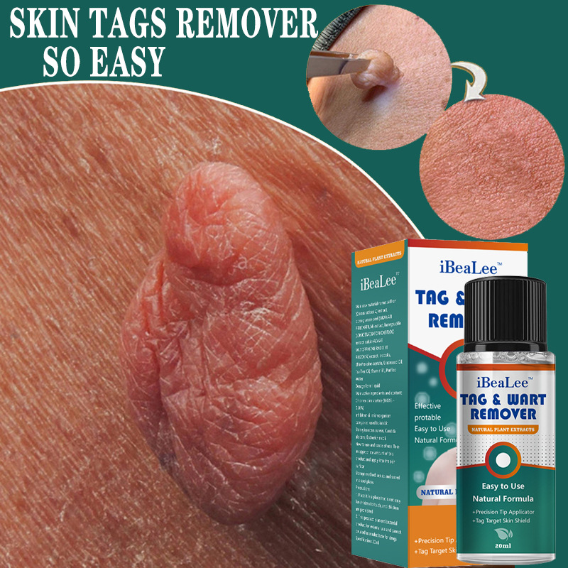 Skin Tag Remover Warts Remover Wart Cream Ct Foot Plaster Warts Skin Care Oil 20ML